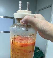 潜江水动力吸脂手术要做多久？